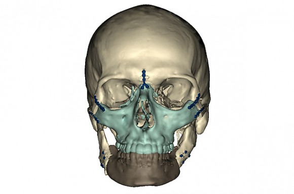 Richard Lee Norris CT scan after surgery