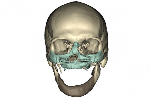 Richard Lee Norris CT scan of face before